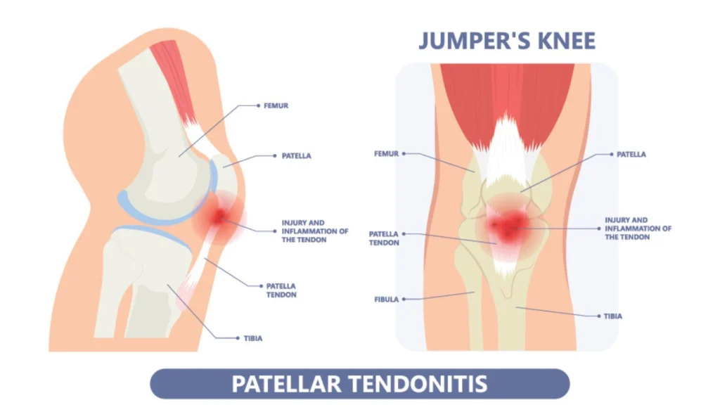 Patellar Tendinitis