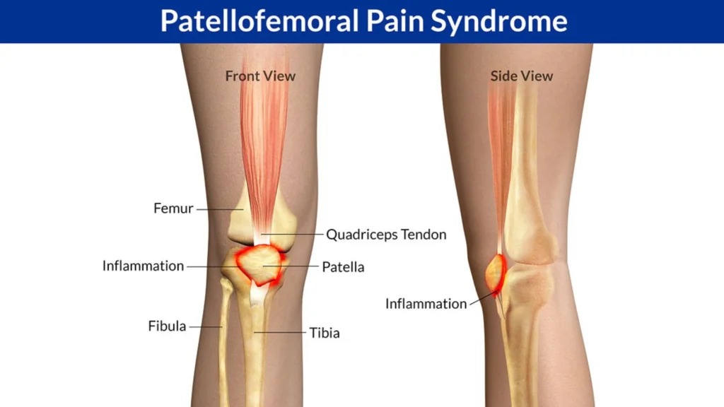 Patellofemoral Pain Syndrome